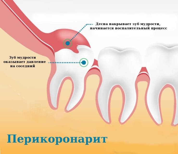 Осложнения при ретенции зубов