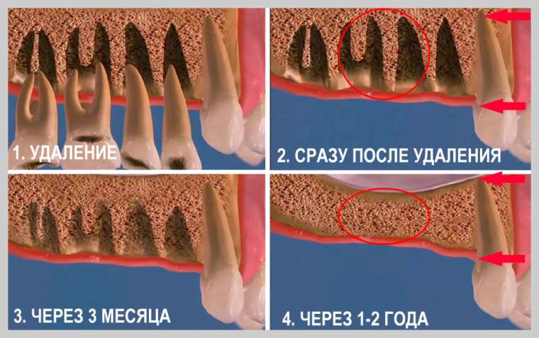 Стадии атрофии костной ткани после удаления зуба