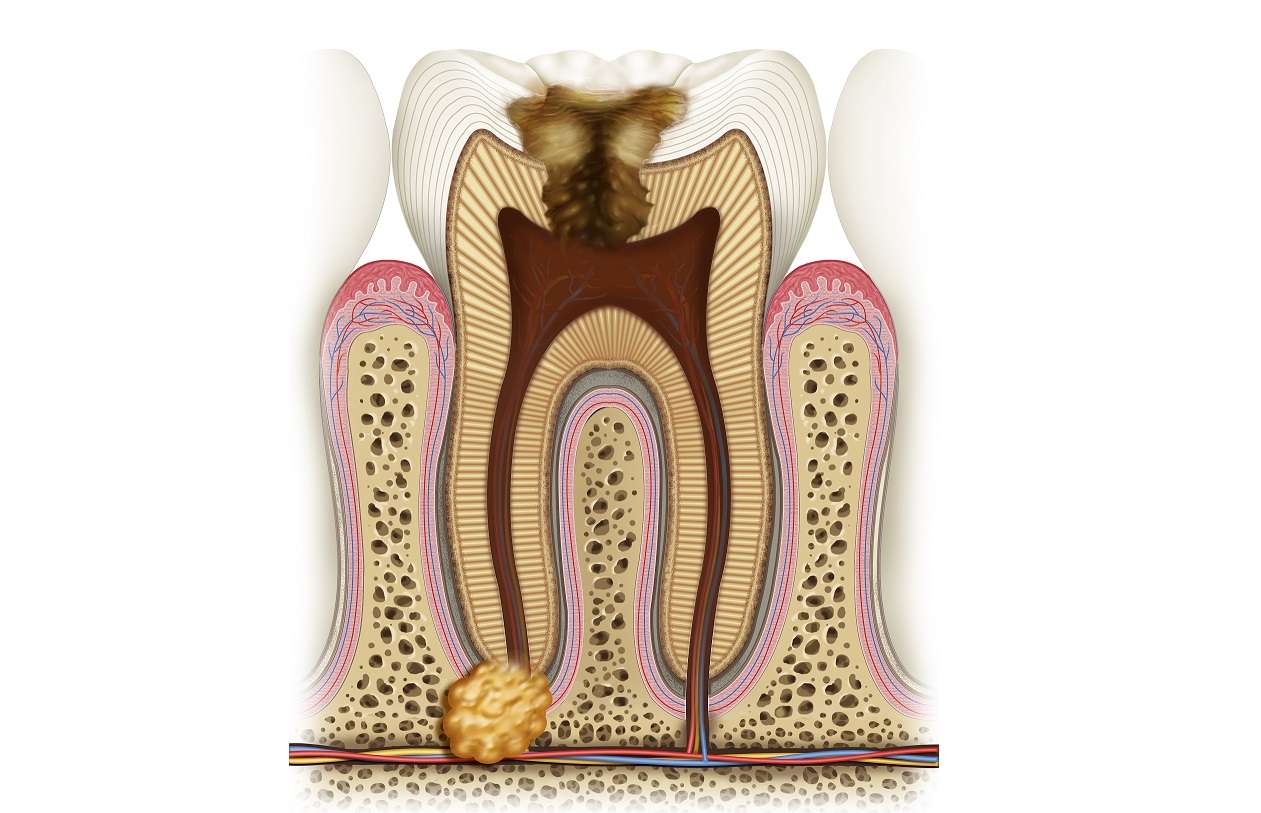 Удаление кисты и гранулемы зуба