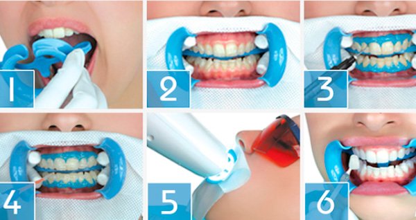 Этапы отбеливания зубов Beyond