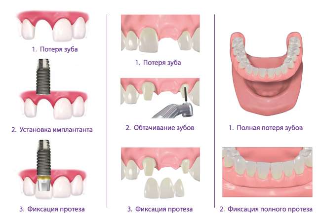 Сравнение преимуществ методов восстановления целостности зубного ряда